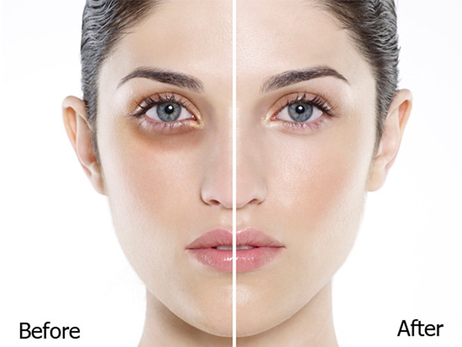 trước và sau khi dùng dầu dừa để chữa thâm mắt