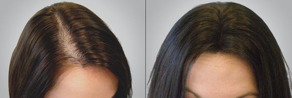 trước và sau khi trị rụng tóc bằng dầu dừa