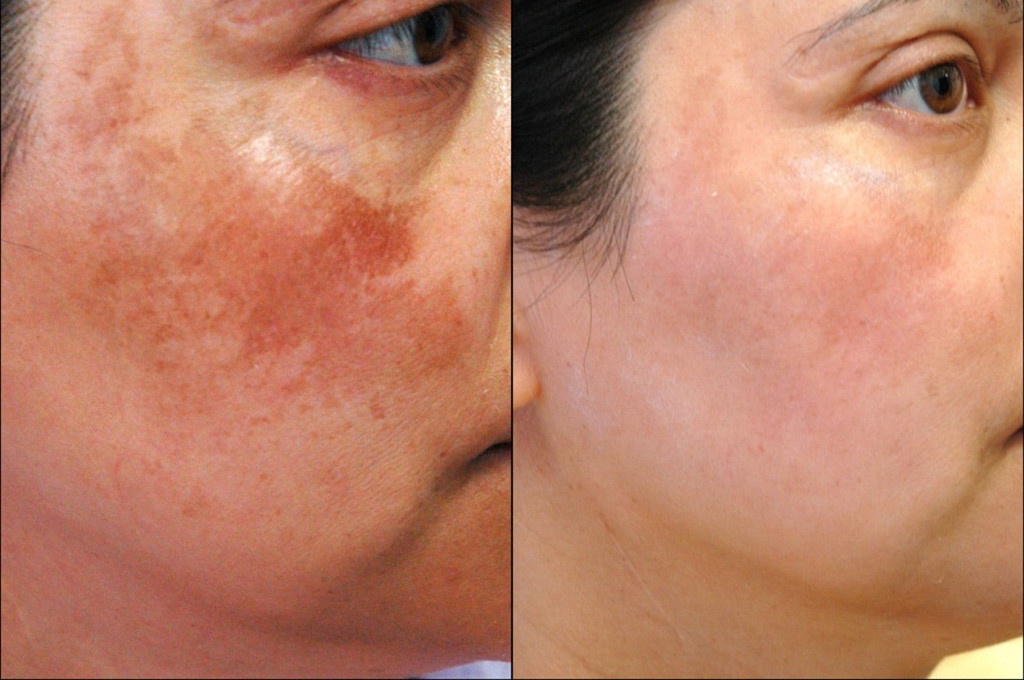 trước và sau khi dùng dầu dừa trị nám da mặt
